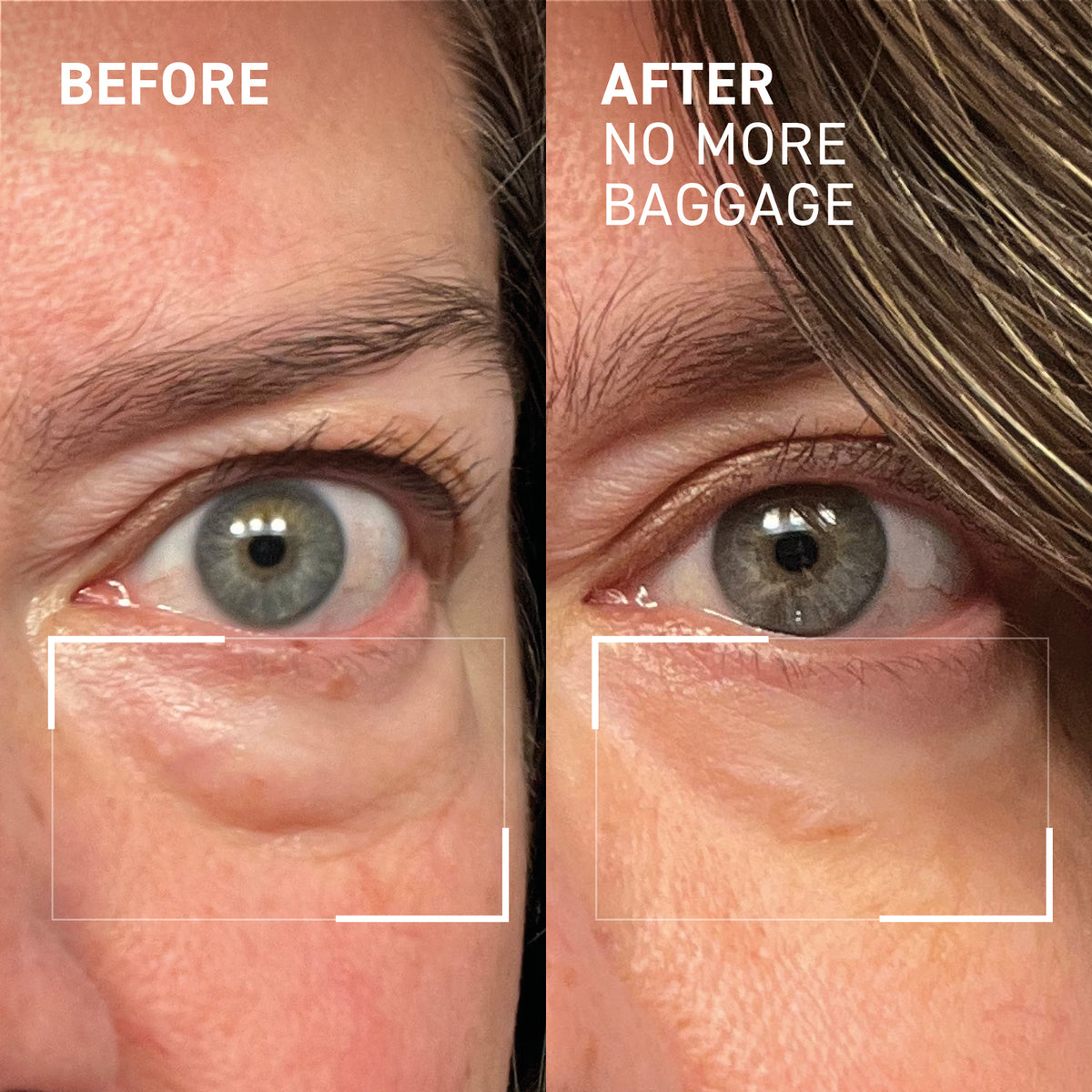 DR. BRANDT needles no more NO MORE BAGGAGE review (Before & After