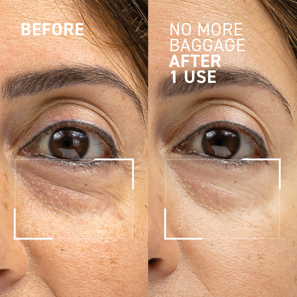 In 3 days Remove Under Eye Bags Completely | Remove Dark Circle, Wrinkles,  Puffy Eyes | Eye bags treatment, Eye wrinkles remedies, Skin care dark spots